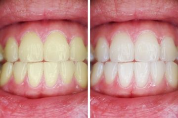 Odontoiatria estetica - 2